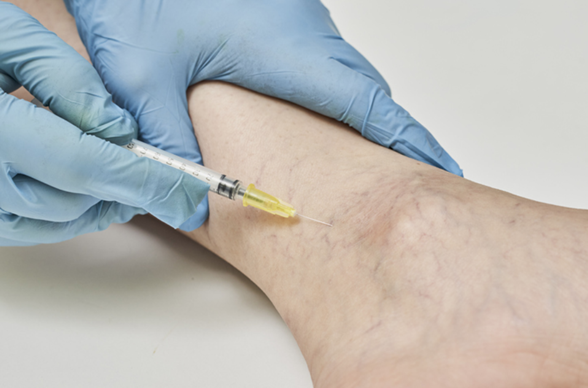 sclerotherapy procedure